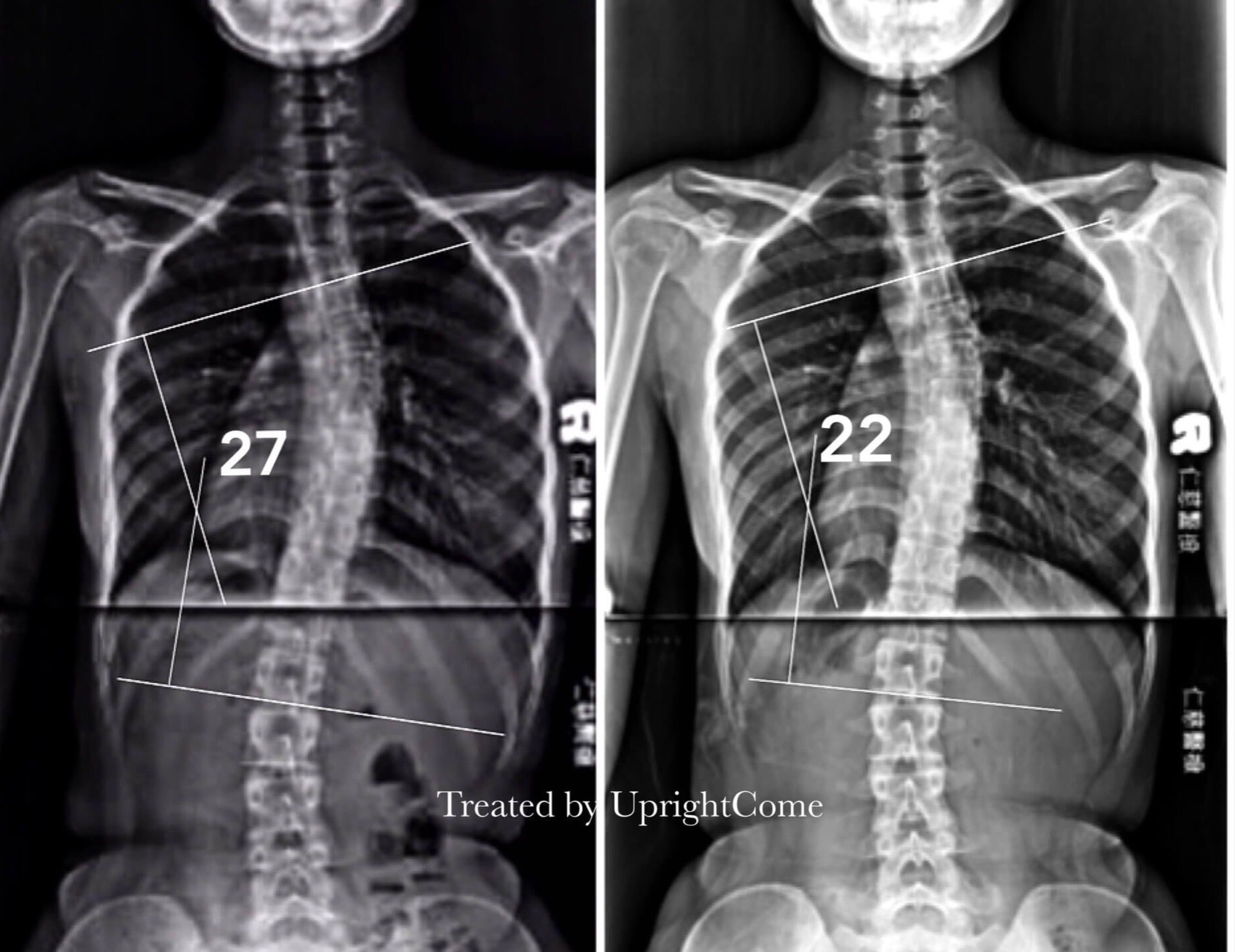 脊椎側彎患者經過側彎矯正治療後，胸椎側彎角度由27度減少到22度。