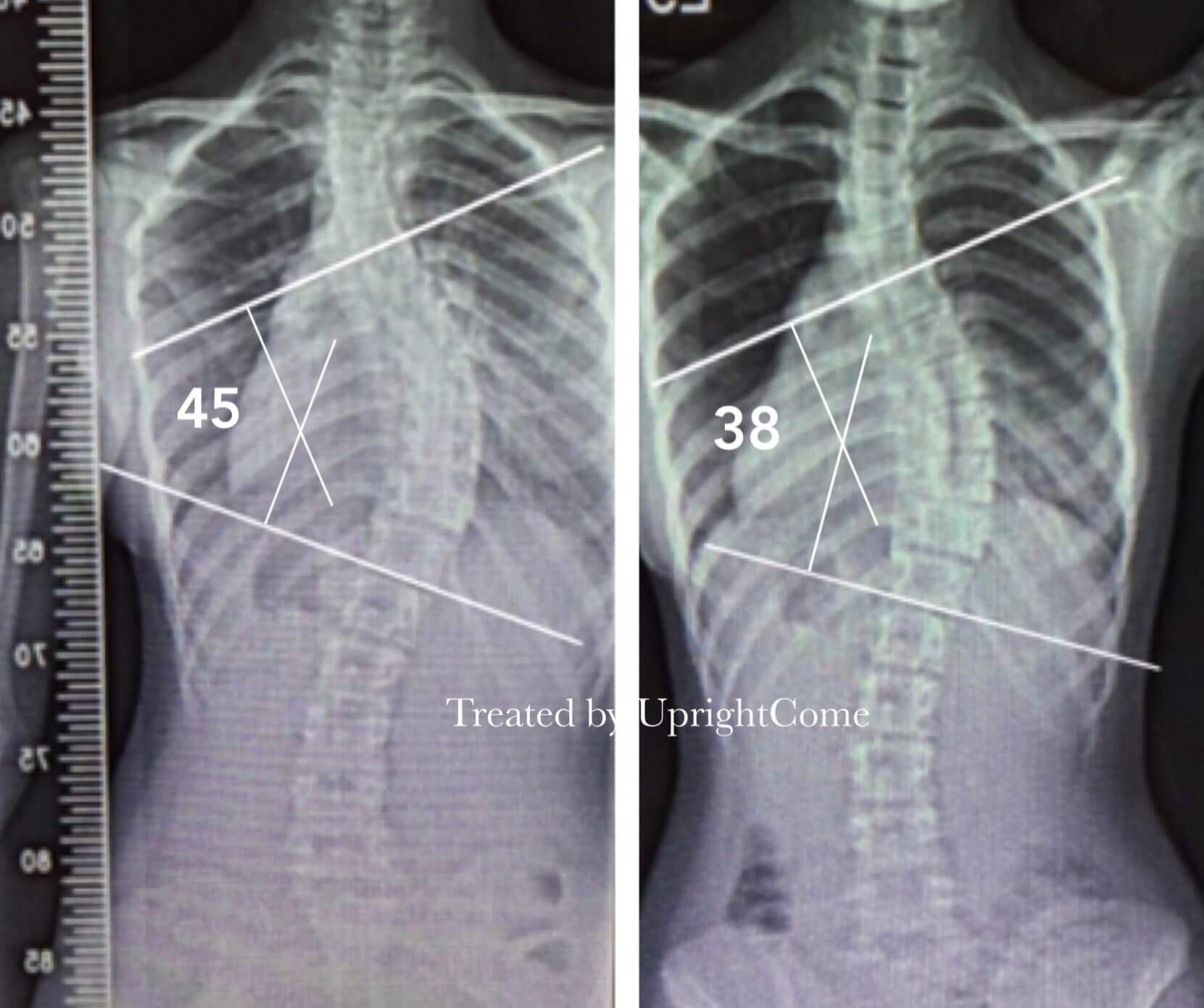 脊椎側彎患者經過側彎矯正治療後，胸椎側彎角度由45度減少到38度。