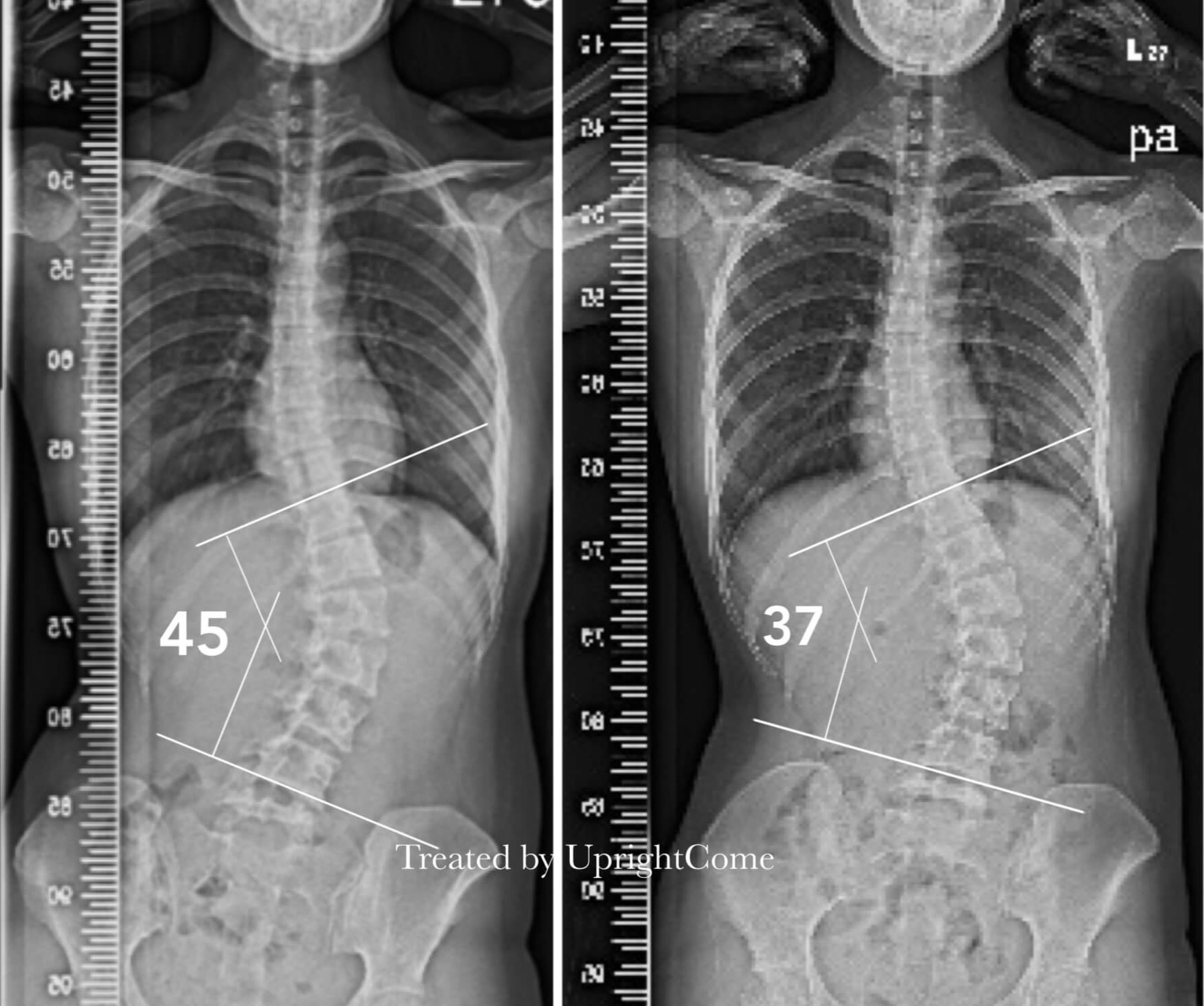 脊椎側彎患者經過側彎矯正治療後，腰椎側彎角度由45度減少到37度。
