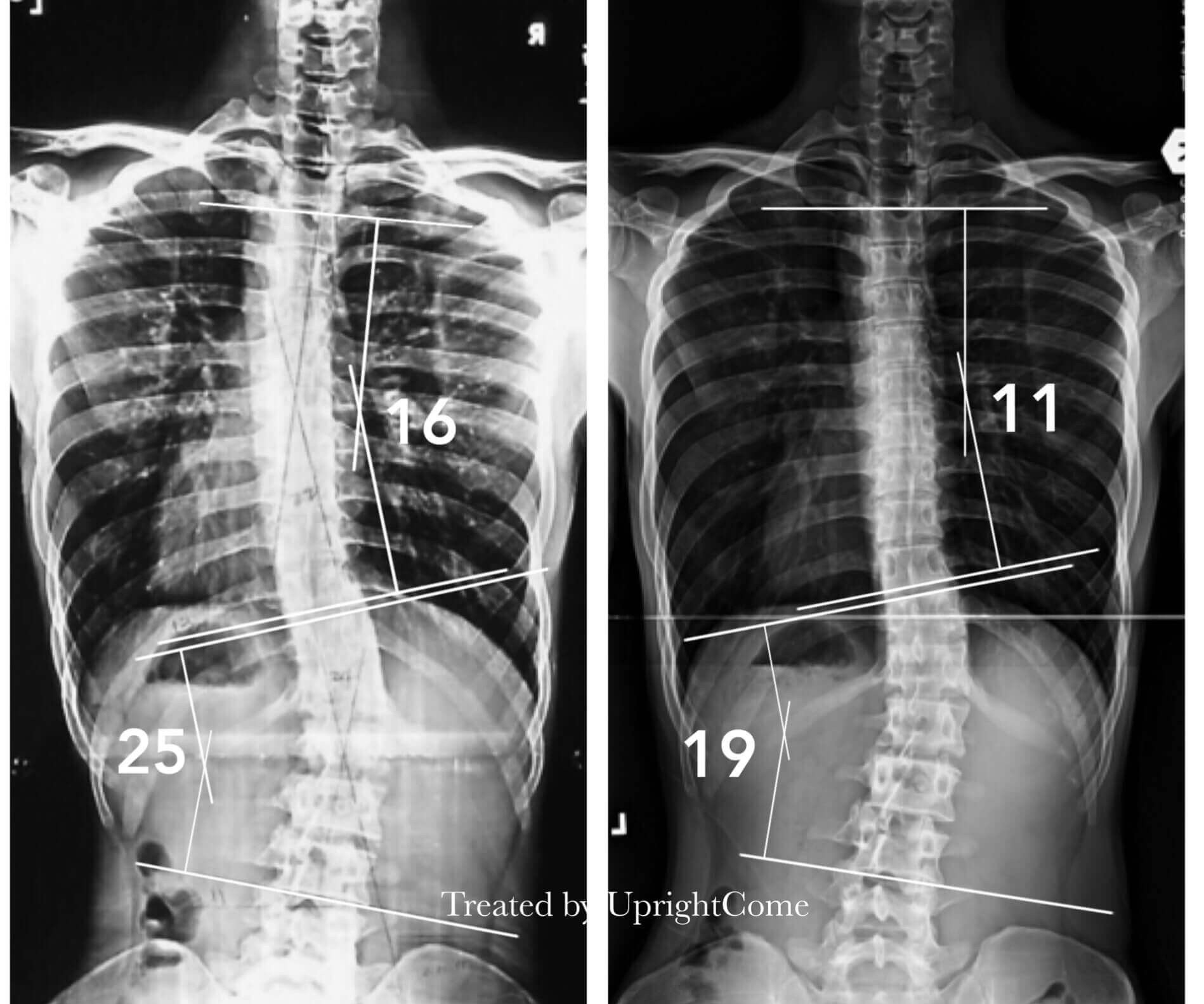 脊椎側彎患者經過側彎矯正治療後，胸椎角度由16度減少到11度，腰椎角度由25度減少到19度。