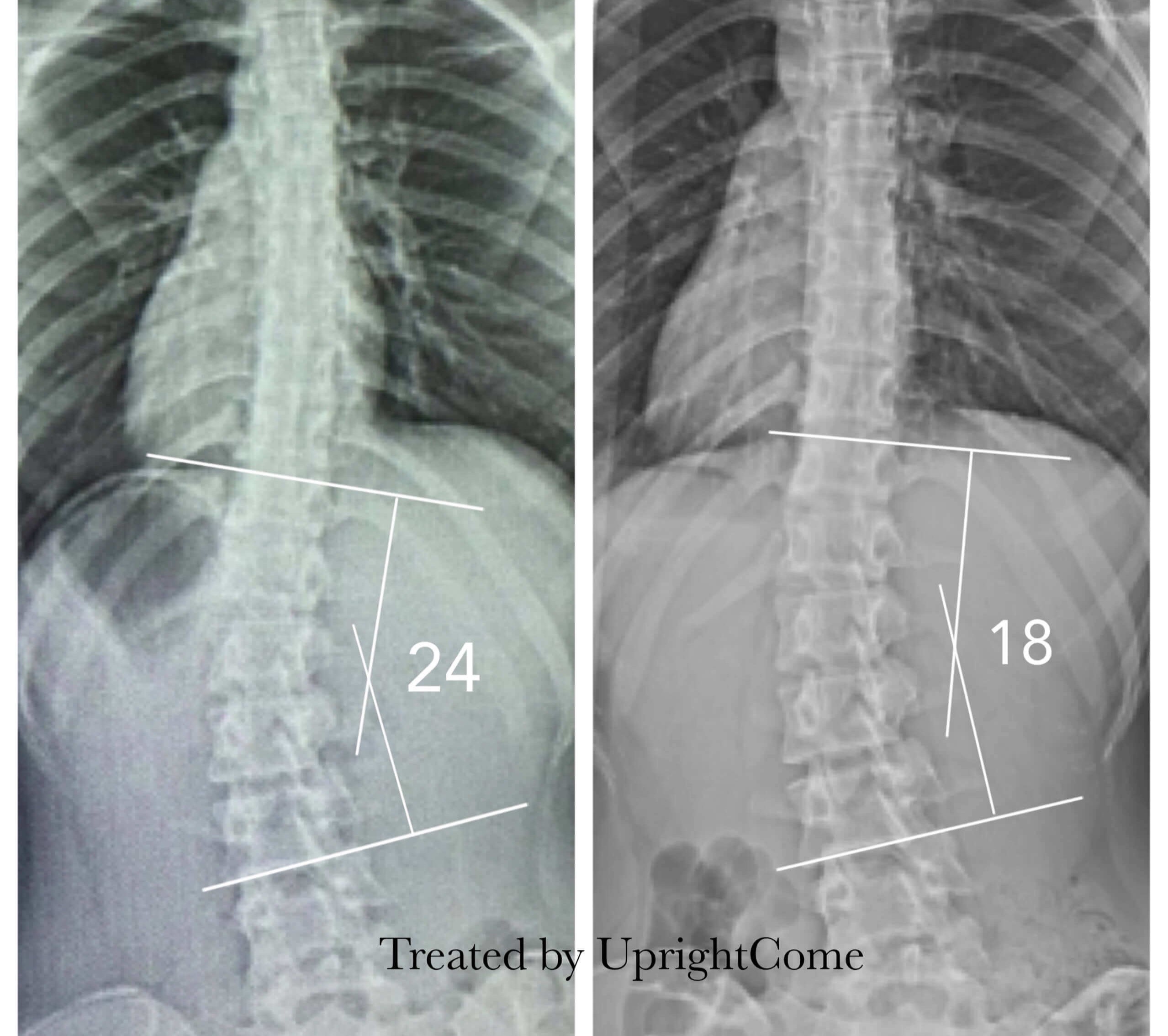 脊椎側彎患者經過側彎矯正治療後，腰椎側彎角度由24度減少到18度。