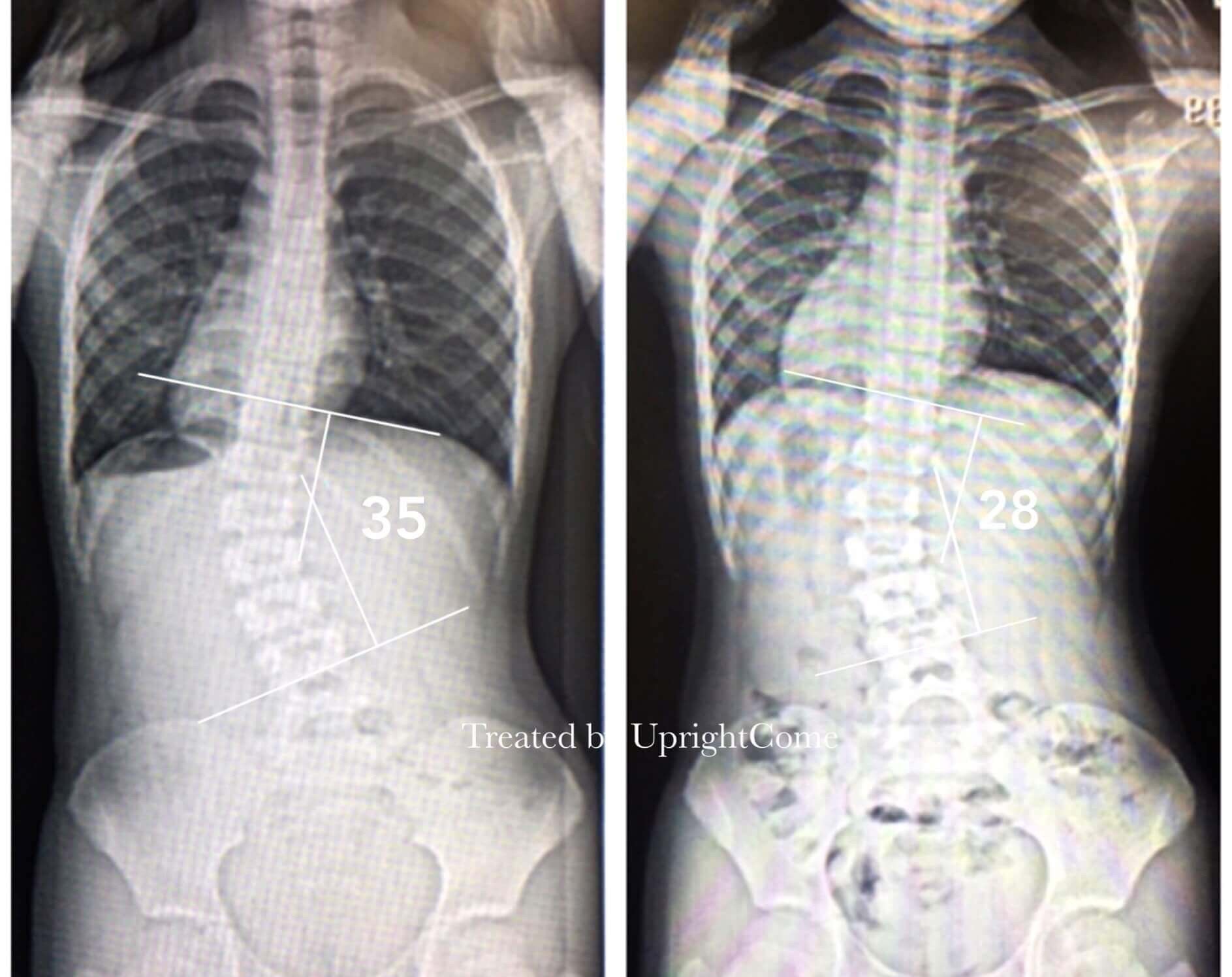 脊椎側彎患者經過側彎矯正治療後，腰椎側彎角度由35度減少到28度。