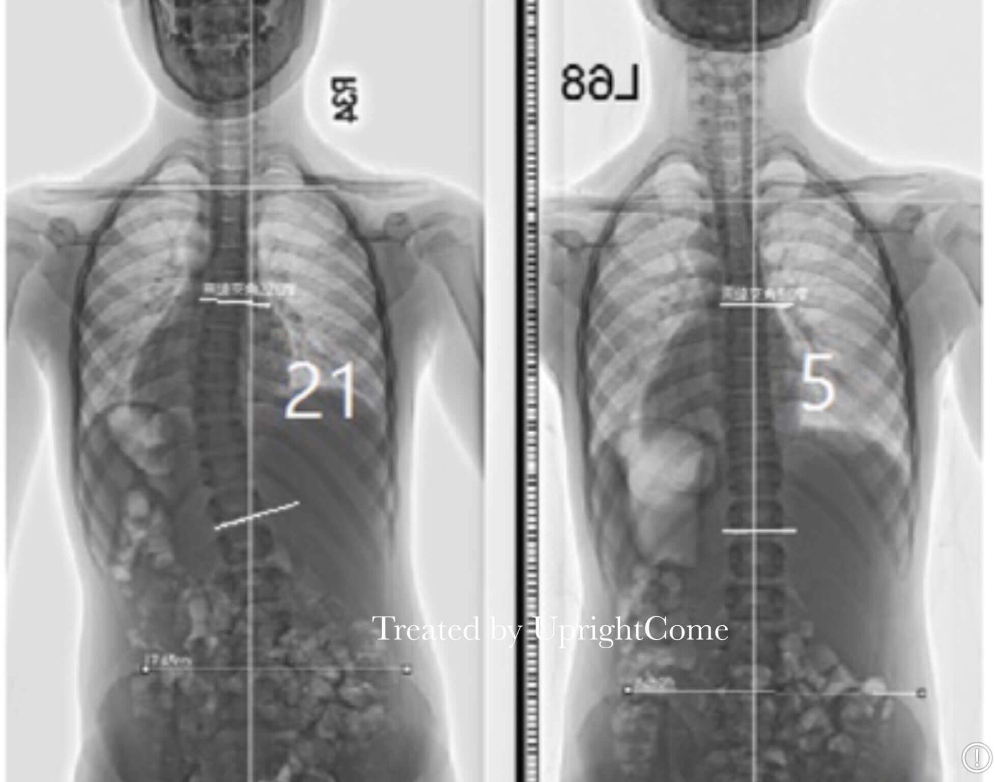 脊椎側彎患者經過側彎矯正治療後，胸椎側彎角度由21度減少到5度。
