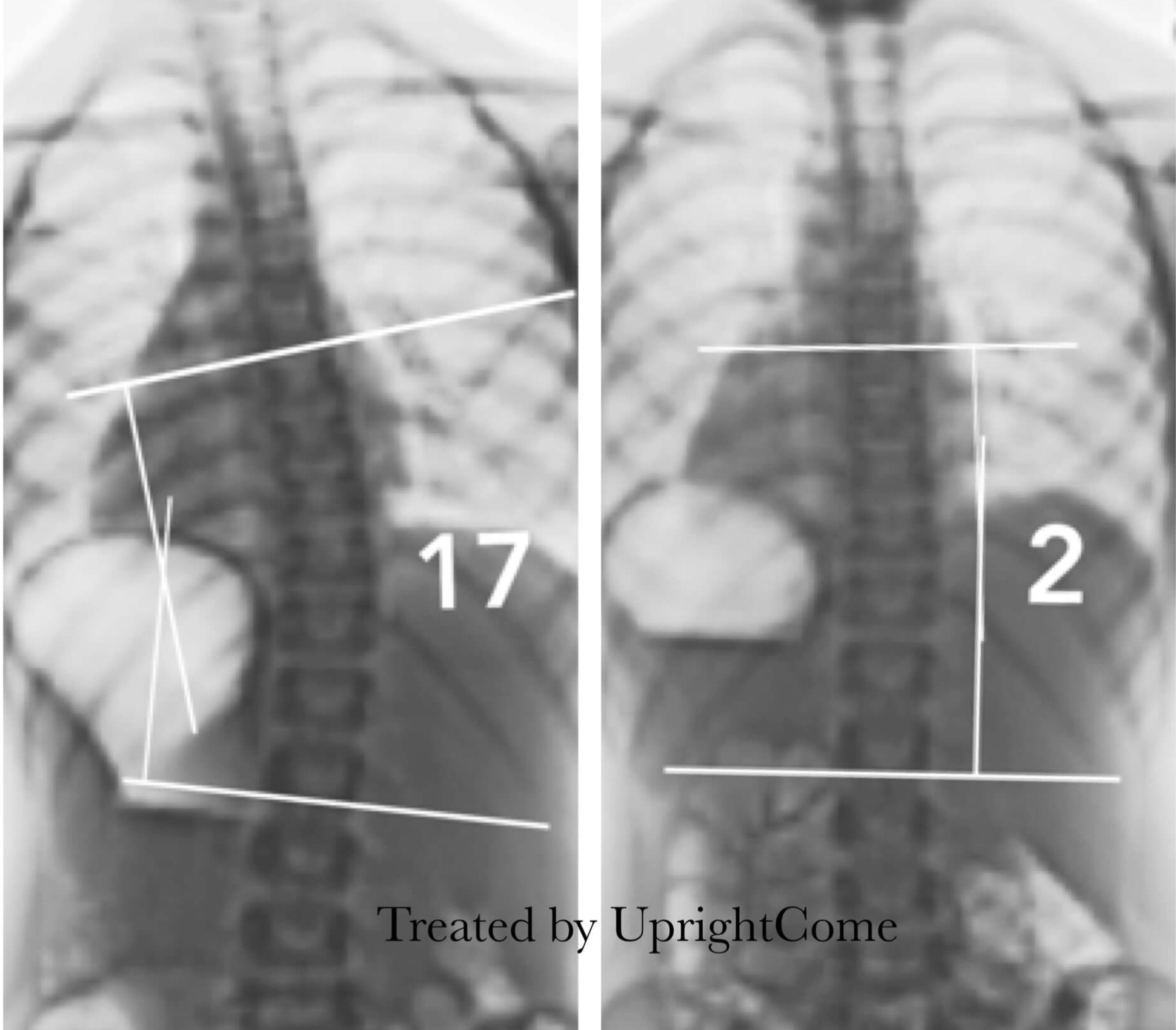 脊椎側彎患者經過側彎矯正治療後，腰椎角度由17度減少到2度。