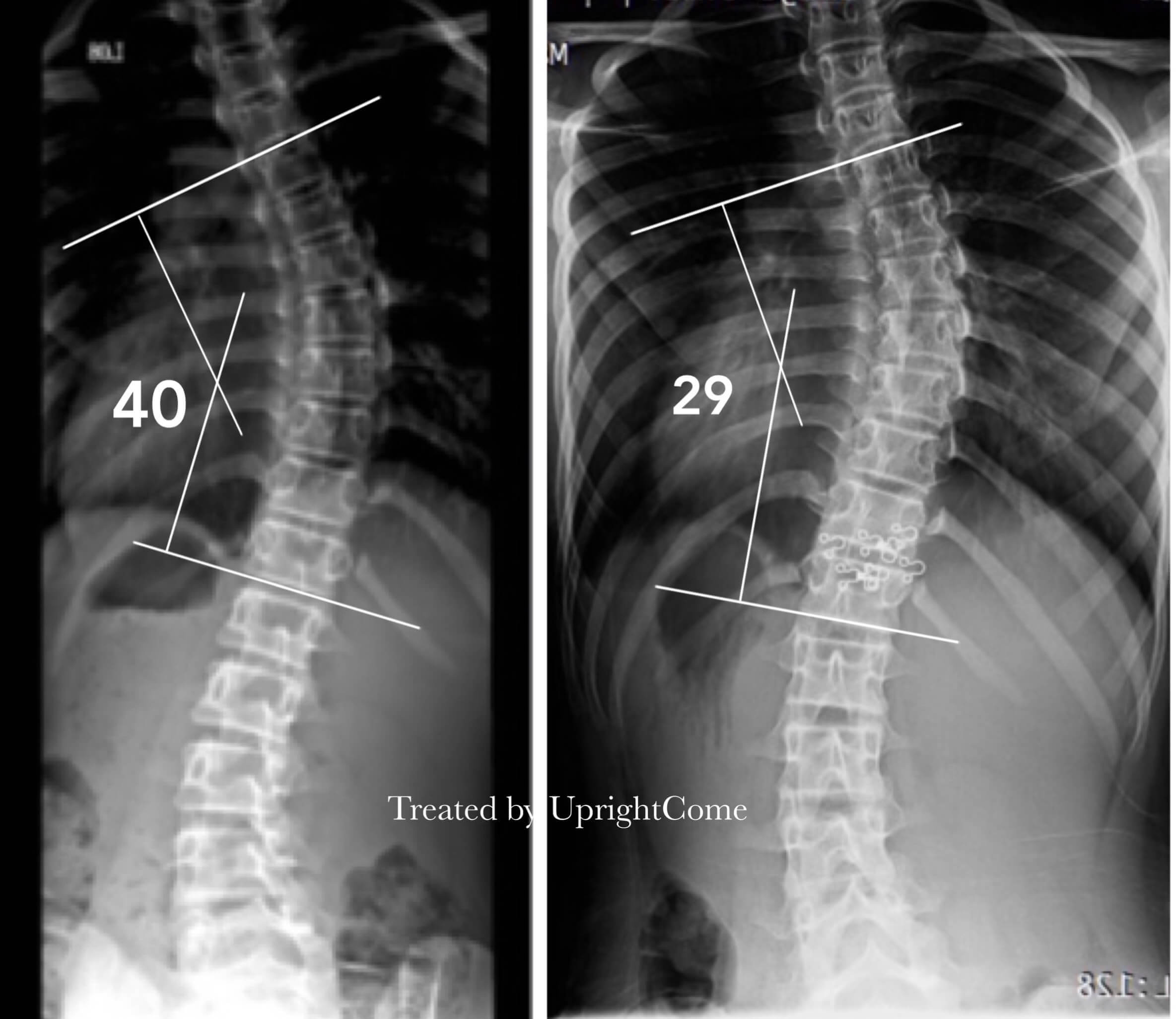 脊椎側彎患者經過側彎矯正治療後，胸椎角度由40度減少到29度。