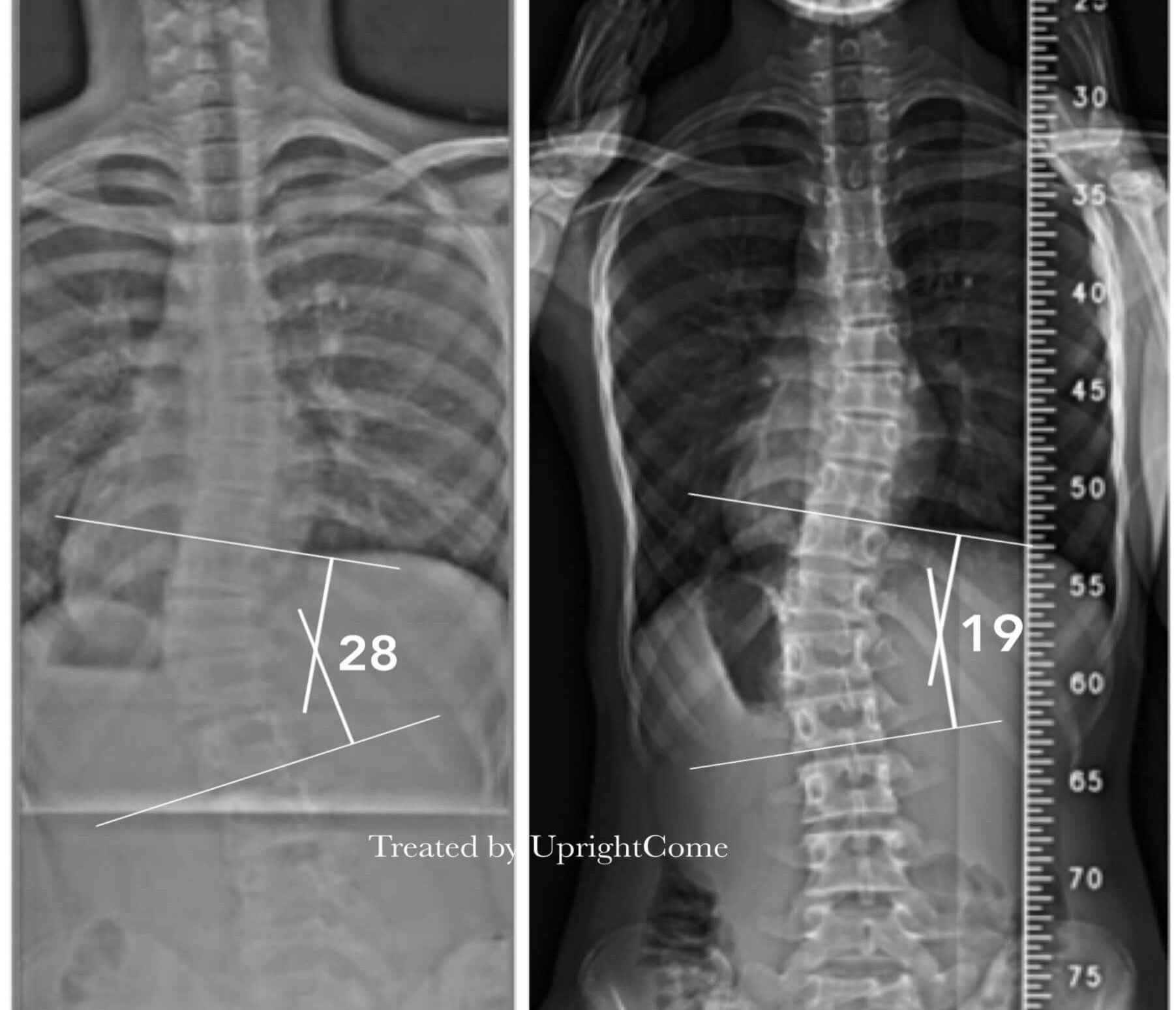 脊椎側彎患者經過側彎矯正治療後，腰椎角度由28度減少到19度。
