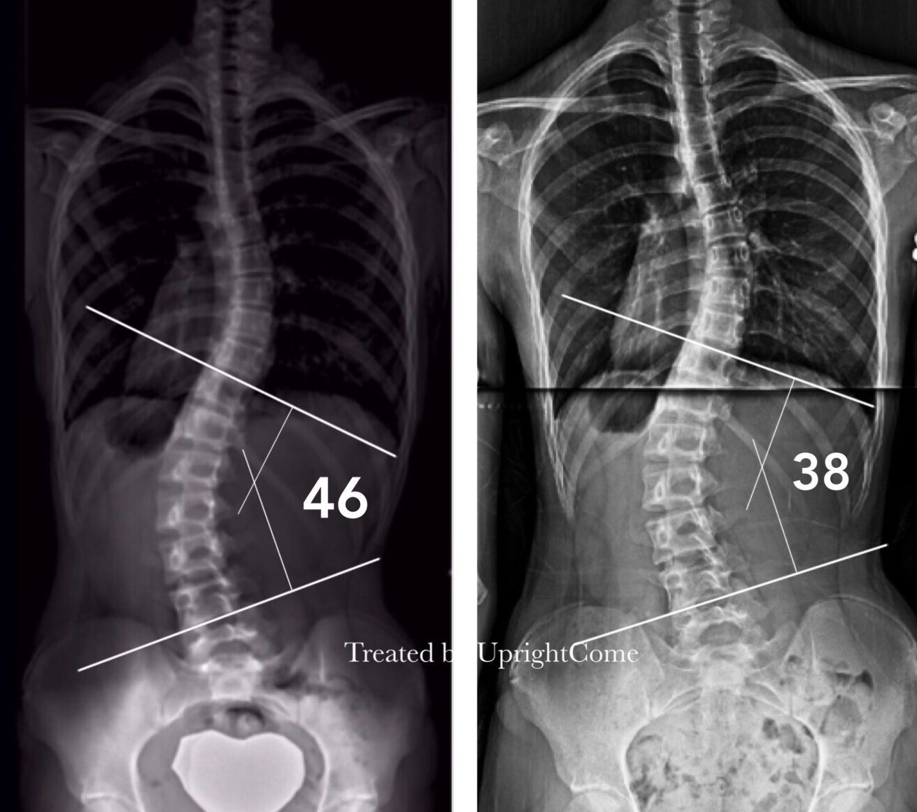 脊椎側彎患者經過側彎矯正治療後，腰椎角度由46度減少到38度。