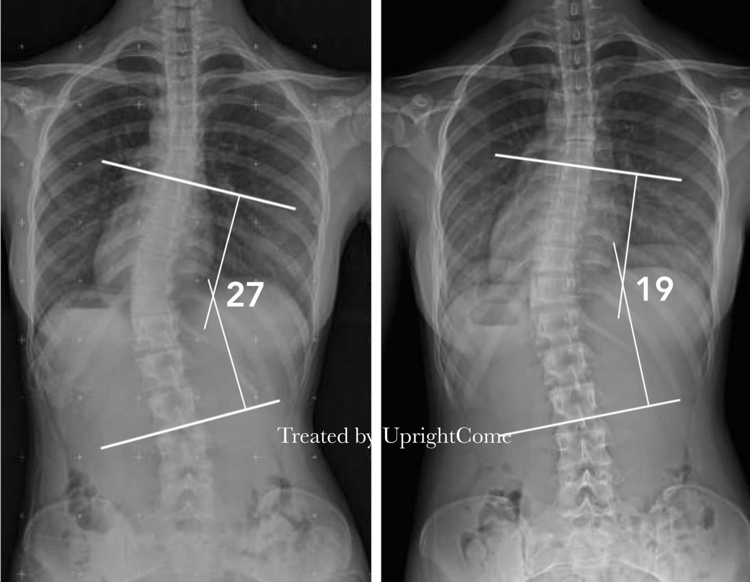 脊椎側彎患者經過側彎矯正治療後，腰椎側彎角度由27度減少到19度。