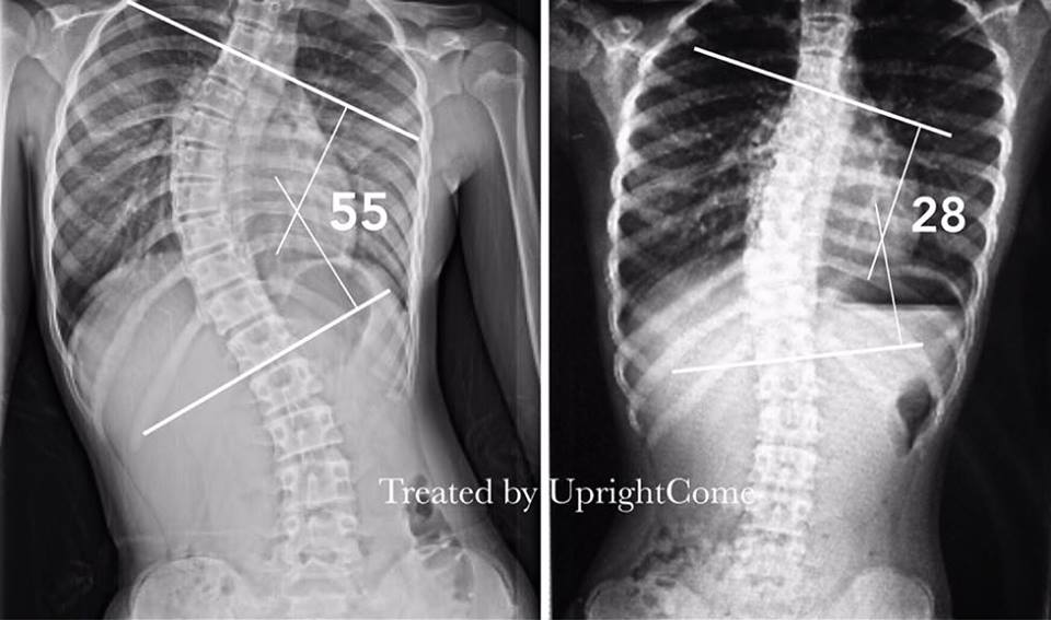 scoliosis treatment outcome  